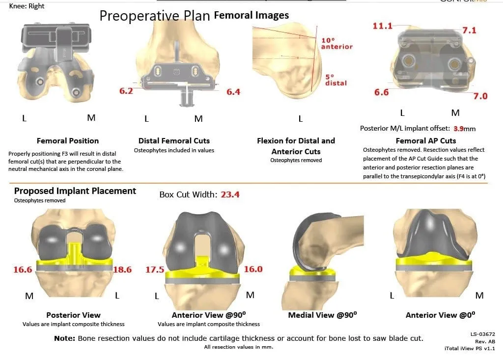 Plan quirúrgico completo específico para pacientes en ortopedia para un reemplazo total de rodilla Right Custom en una mujer de 68 años - escaneo 2