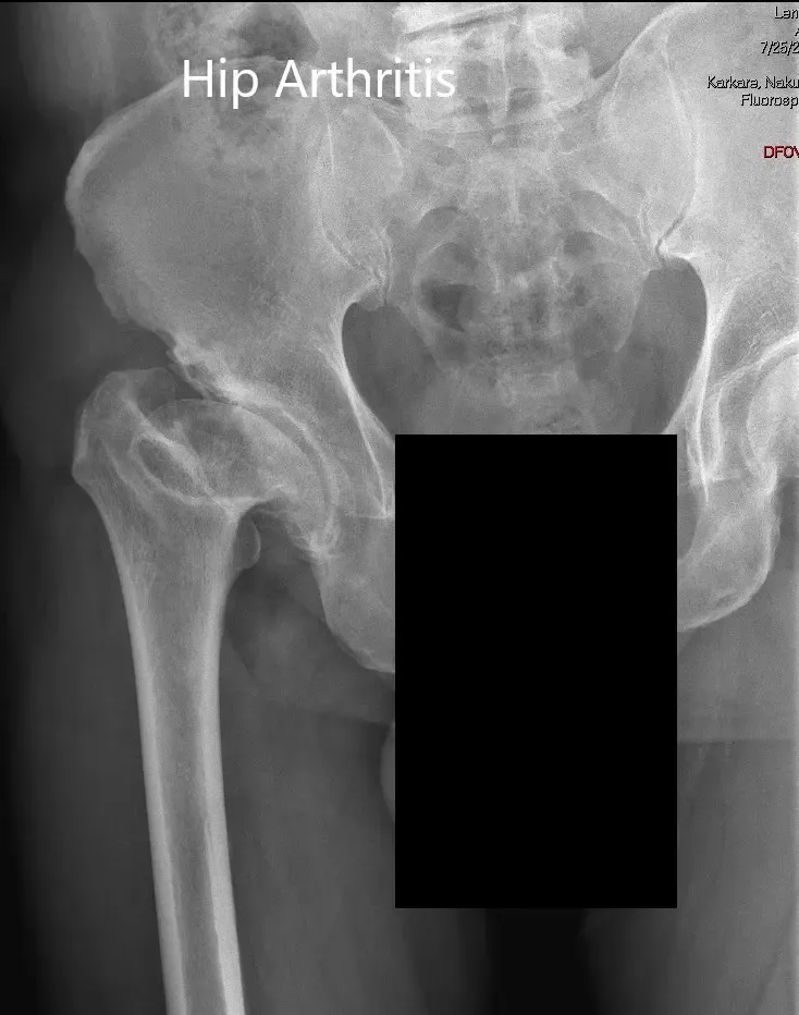 AP and lateral views of the right hip joint 