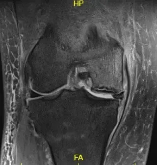 Imagen ponderada en T2 que muestra la sección coronal de la rodilla con la señal alterada de la médula ósea y la señal del borde