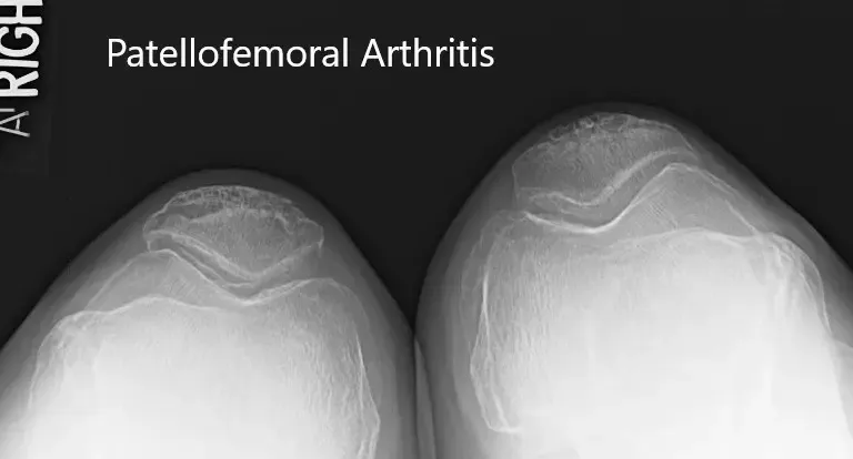 Radiografía preoperatoria mostrando la vista comercial de ambas rodillas