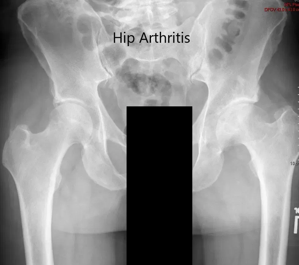 Preoperative X-ray of the pelvis showing AP view of the pelvis with both hips Preoperative X-ray of the pelvis showing AP view of the pelvis with both hips