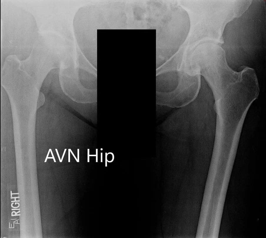 X-ray showing the AP view of the pelvis with both hip joints