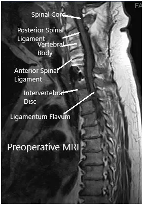 Preoperative MRI in the sagittal section Preoperative MRI in the sagittal section