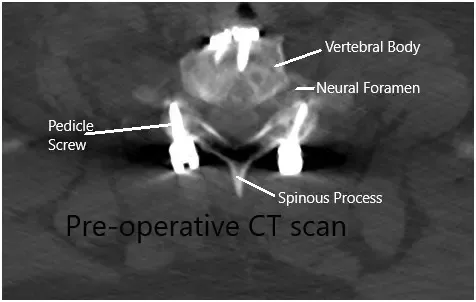 Preoperative CT scan in the axial section Preoperative CT scan in the axial section