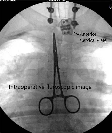 Intraoperative fluoroscopic image Intraoperative fluoroscopic image