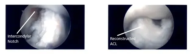 Imágenes artroscópicas intraoperatorias de la rodilla izquierda 3