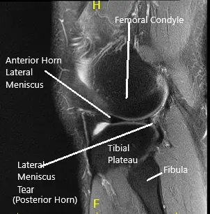 MRI of the Knee in coronal and sagittal sections 2