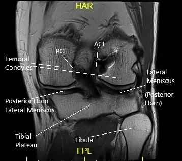 Vista de la resonancia coronal de la rodilla izquierda