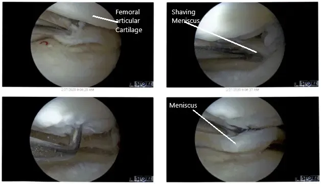 Vistas artroscópicas intraoperatorias de la rodilla izquierda 2