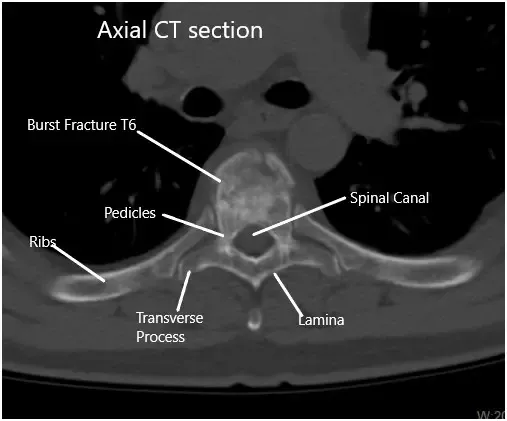 TAC preoperatorio de la columna toracolumbar en sección axial en T6