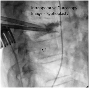 Imágenes de fluoroscopia intraoperatoria 2