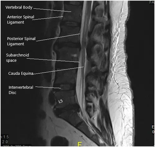 MRI of the lumbosacral spine in sagittal and axial views MRI of the lumbosacral spine in sagittal and axial views