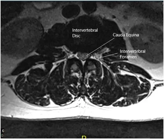 MRI of the lumbosacral spine in sagittal and axial views 2 MRI of the lumbosacral spine in sagittal and axial views 2