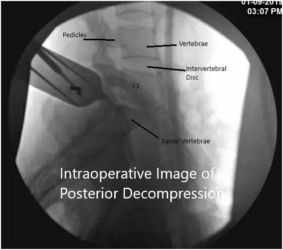 Intraoperative fluoroscopic image Intraoperative fluoroscopic image