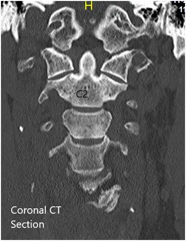 TAC coronal y axial preoperatoria