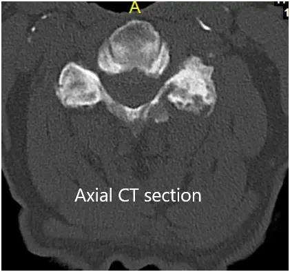 Secciones CT coronales y axiales preoperatorias 2