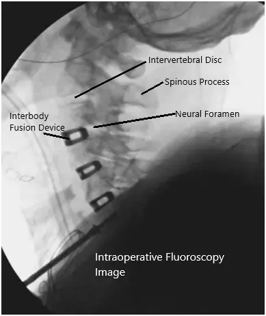 Imágenes fluoroscópicas intraoperatorias