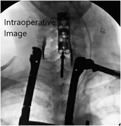 Imágenes fluoroscópicas intraoperatorias 3