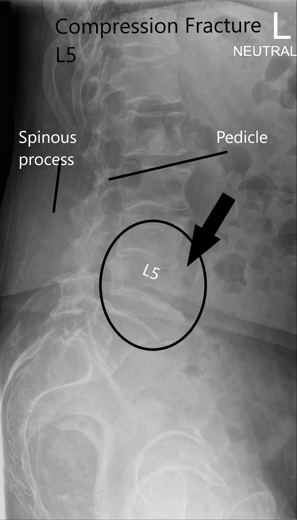 X-ray of LS spine in AP and Lateral views showing significant compression fracture L5 2 X-ray of LS spine in AP and Lateral views showing significant compression fracture L5 2