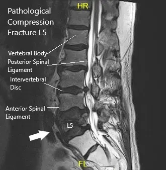 MRI showing Sagittal Section of Lumbar Sacral Spine MRI showing Sagittal Section of Lumbar Sacral Spine