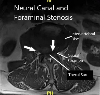 MRI showing Axial Section MRI showing Axial Section