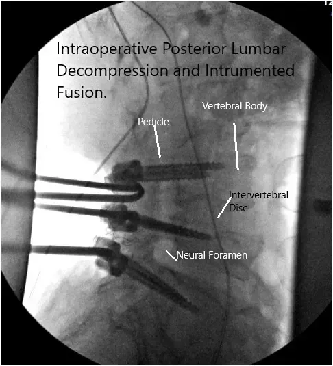 Intraoperative fluoroscopy images 2 Intraoperative fluoroscopy images 2