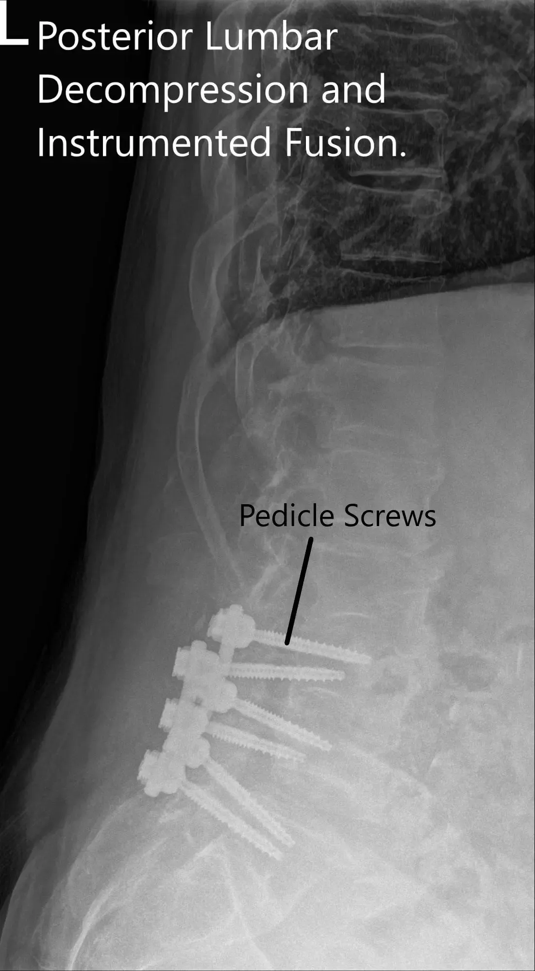 Postoperative X-ray showing AP and Lateral Views 2 Postoperative X-ray showing AP and Lateral Views 2