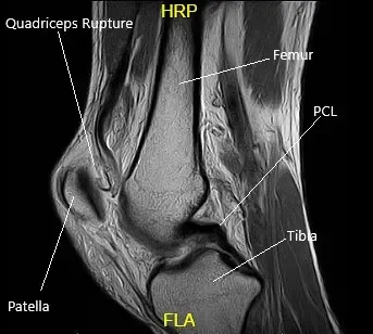 MRI of the Left Knee in the sagittal section