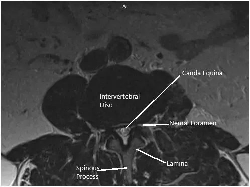 Resonancia magnética de la columna lumbosasacra en secciones sagital y axial 2