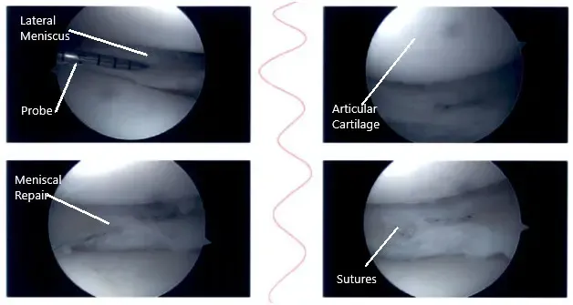 Intraoperative knee arthroscopic images 4