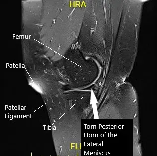 Imagen sagital de la rodilla izquierda con resonancia magnética sagital
