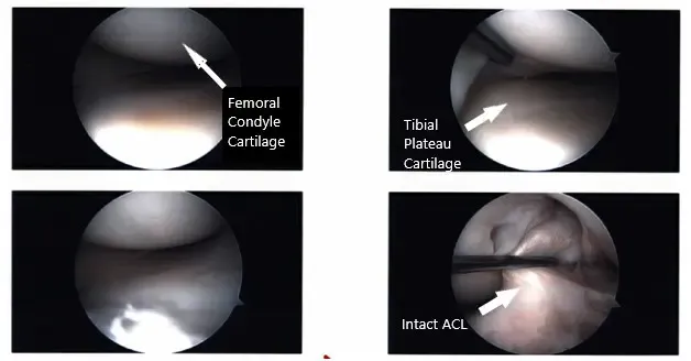 Imágenes artroscópicas intraoperatorias de la rodilla izquierda 2