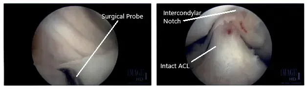 Imágenes artroscópicas intraoperatorias de la rodilla derecha