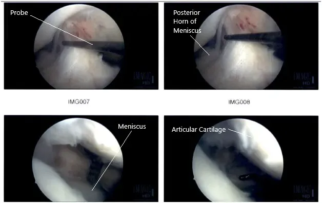 Imágenes artroscópicas intraoperatorias de la rodilla derecha
