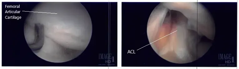 Imágenes intraoperatorias con artroscopio 3