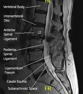 MRI of the LS spine in sagittal section