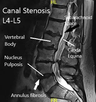 Resonancia magnética de la columna lumbar