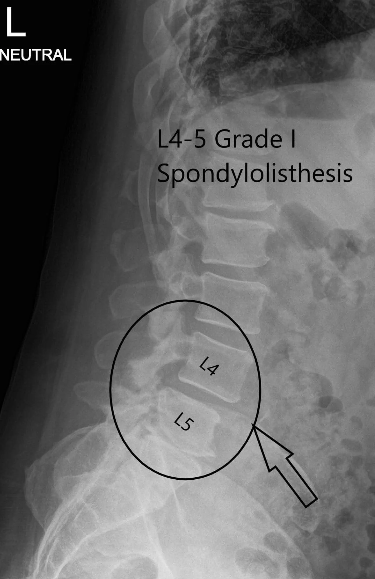 Preoperative X-ray LS spine in AP and Lateral Views 2