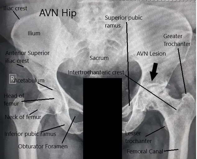 Radiografía de ambas articulaciones de la cadera que muestra el AVN de la cadera izquierda