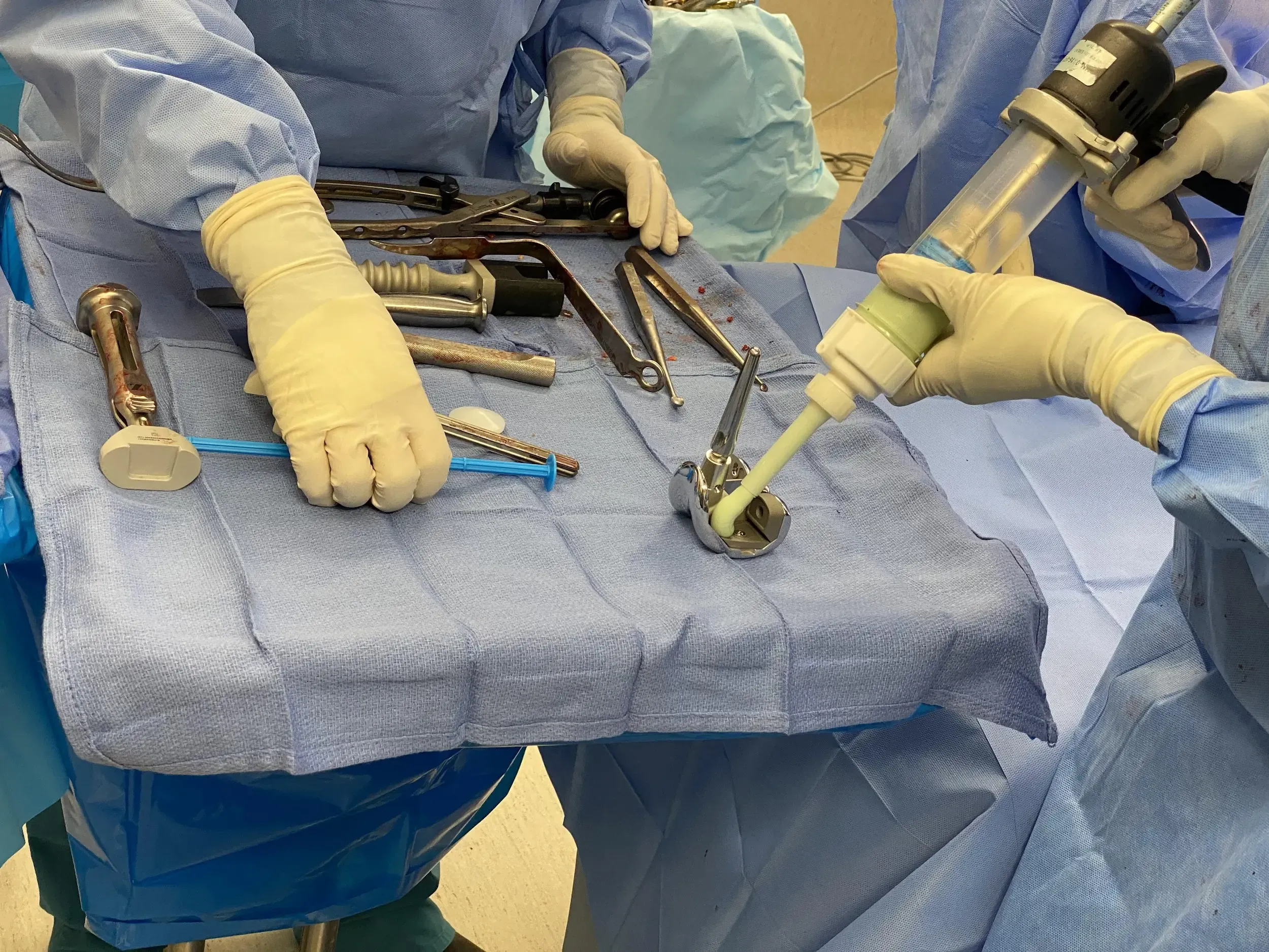 Cementación del componente femoral Cementación del componente femoral