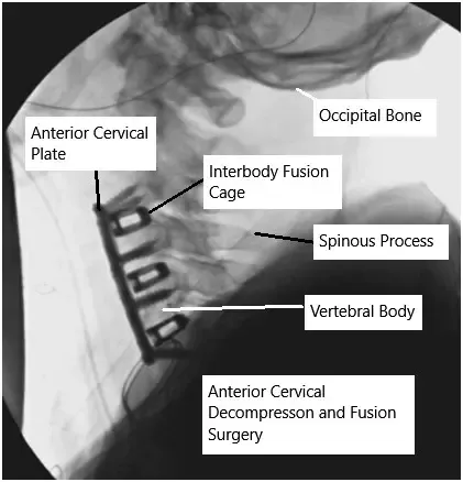 Imagen de fluoroscopia intraoperatoria que muestra la descompresión cervical anterior y la fusión.