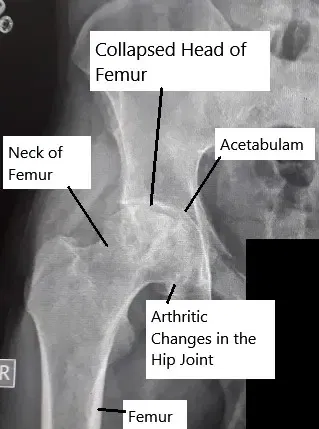 X-ray showing avascular necrosis of the hip joint