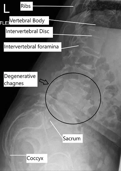 X-ray showing lumbar degenerative disc disease.