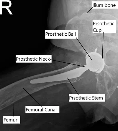 Reemplazo total de cadera en radiografía en vista lateral con pata de rana.