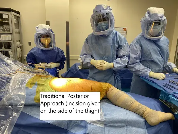 Abordaje posterior tradicional para la prótesis de cadera