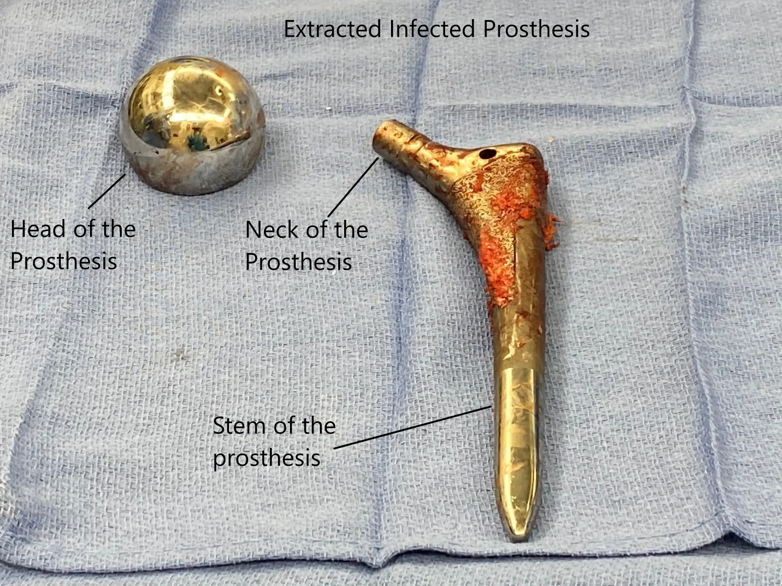 Infected prosthesis after removal.