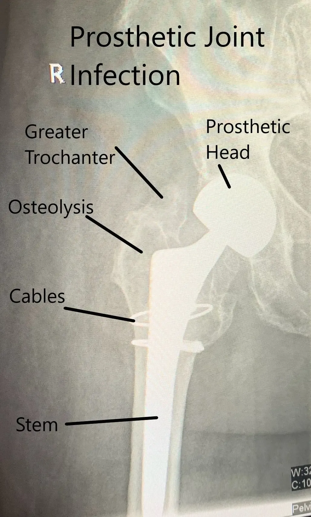 X Ray showing prosthetic joint infection