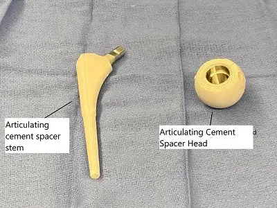 Revision Hip Replacement1