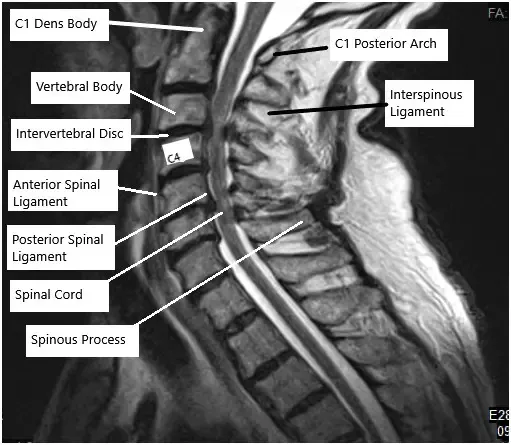 Resonancia magnética de la columna cervical