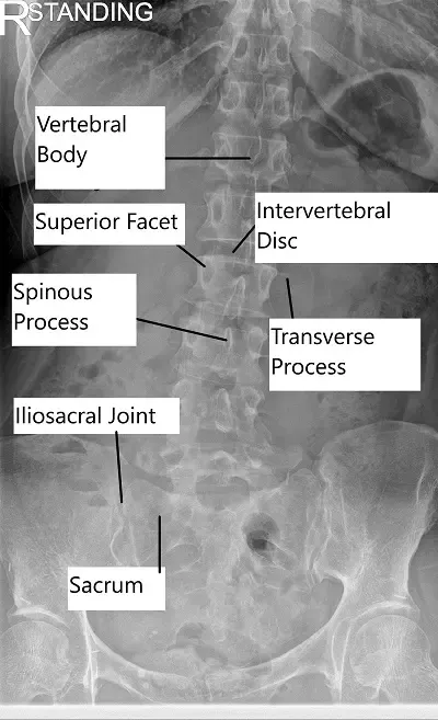 Radiografía de la columna lumbar.